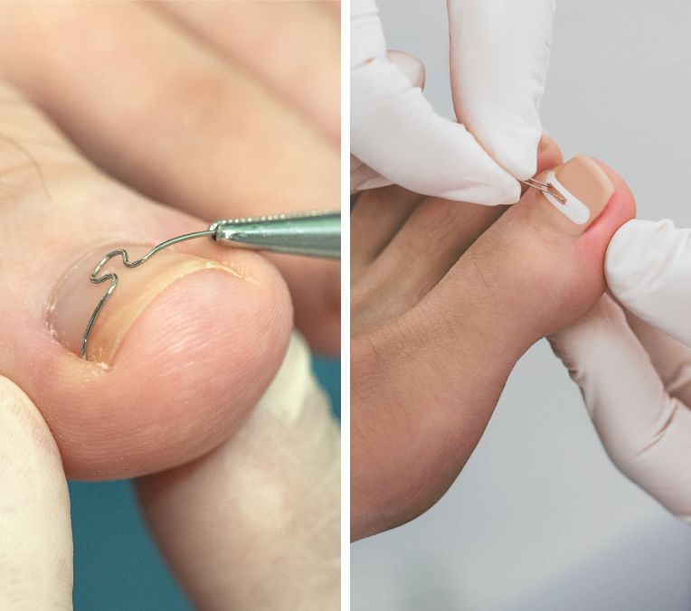 Podologia em Várzea Paulista - cuidados profissionais com os pés